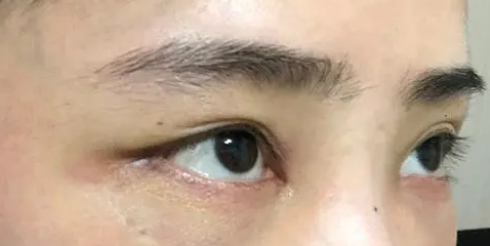 去眼袋手术