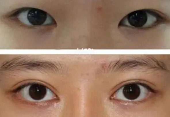 双眼皮手术