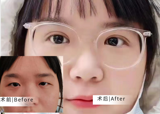 双眼皮手术