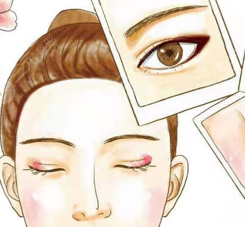 双眼皮手术