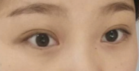 双眼皮手术