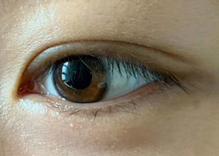 双眼皮手术