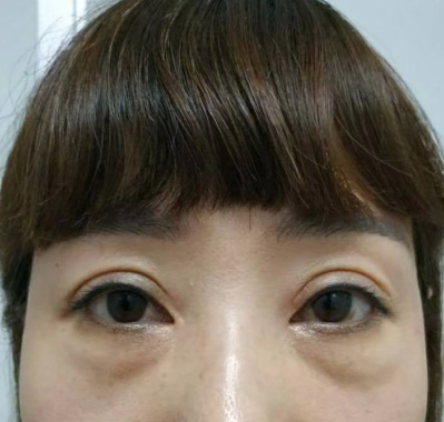 去眼袋手术