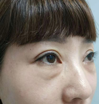 去眼袋手术