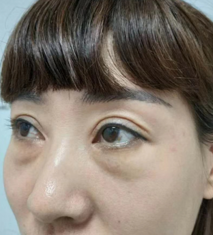 去眼袋手术