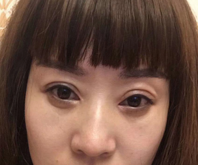 去眼袋手术