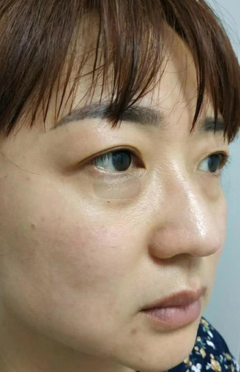 去眼袋手术