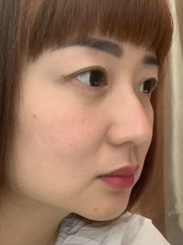 去眼袋手术