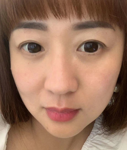 去眼袋手术