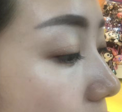 去眼袋手术的经历繁琐吗？几天看到效果？121
