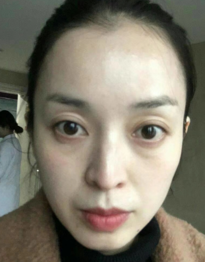 去眼袋手术