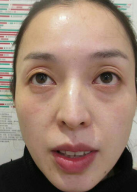 去眼袋手术