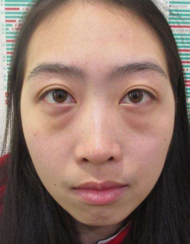 去眼袋手术