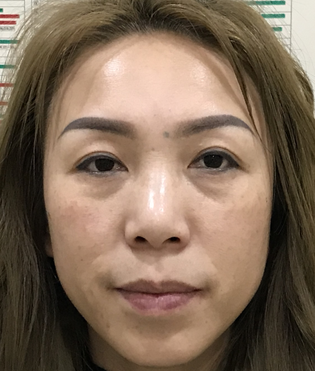 去眼袋手术