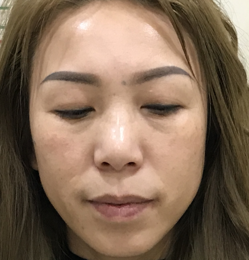 去眼袋手术