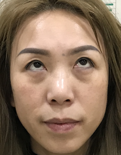 去眼袋手术