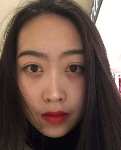 去眼袋手术