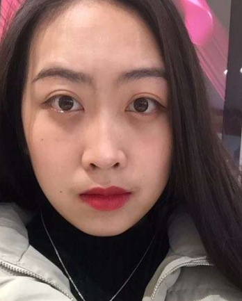 去眼袋手术