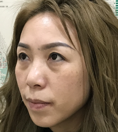 去眼袋手术