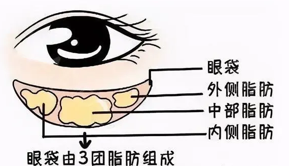 去眼袋手术