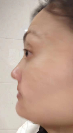 去眼袋手术