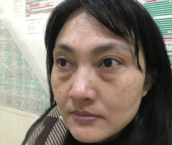 去眼袋手术