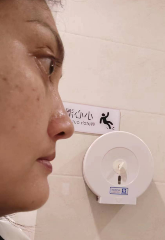 去眼袋手术