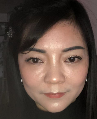 去眼袋手术