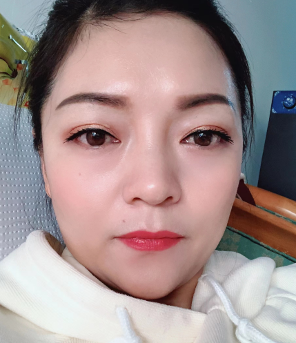 去眼袋手术