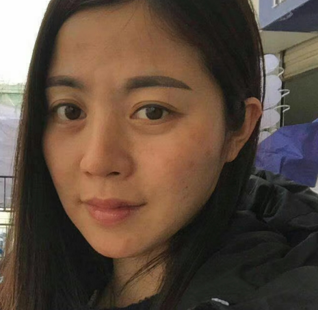 去眼袋手术