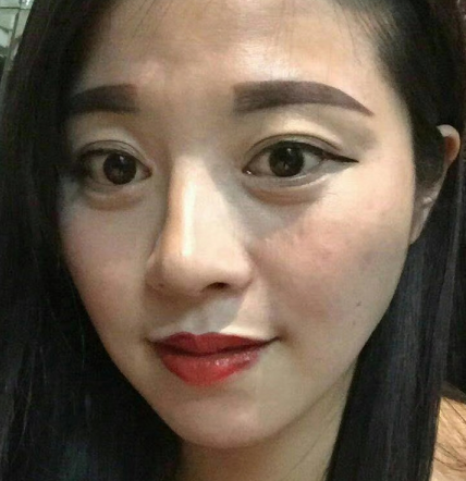 去眼袋手术