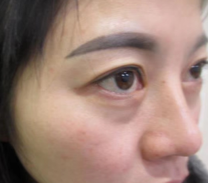 去眼袋手术