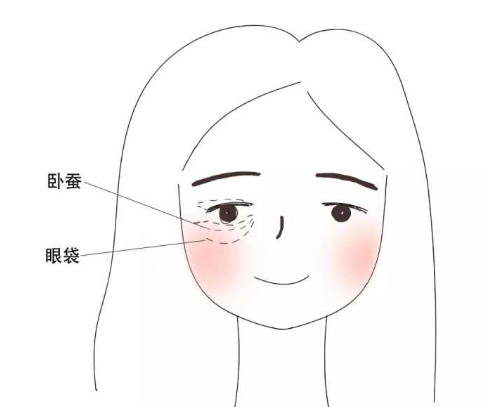 去眼袋手术