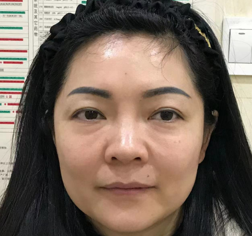 去眼袋手术