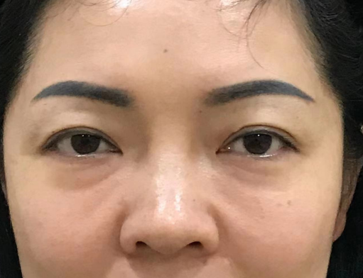 去眼袋手术