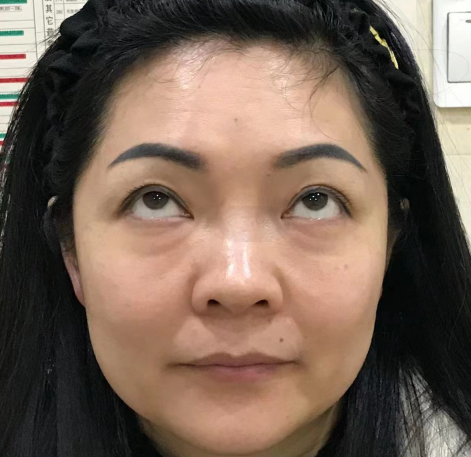 去眼袋手术