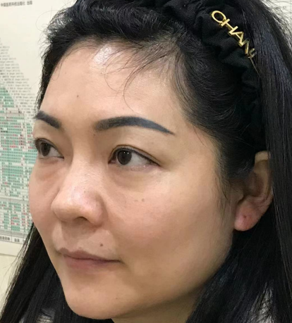 去眼袋手术