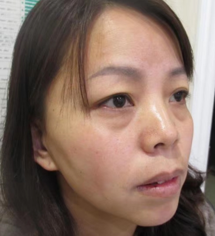 去眼袋手术