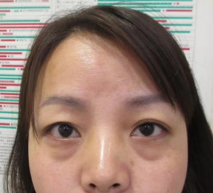 去眼袋手术