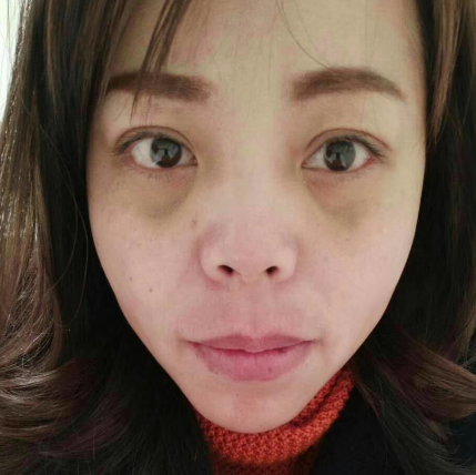 去眼袋手术