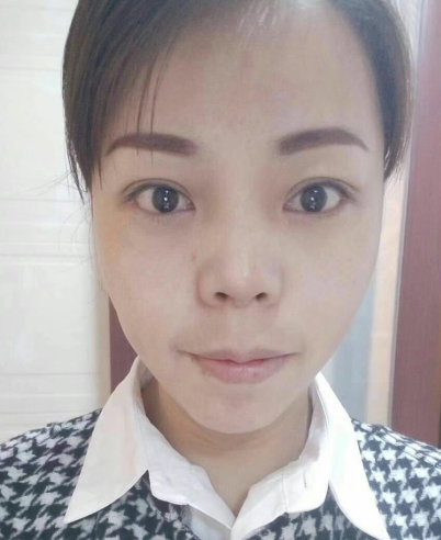 去眼袋手术