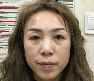 去眼袋手术