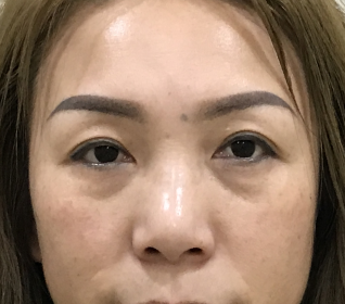 去眼袋手术