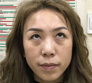 去眼袋手术