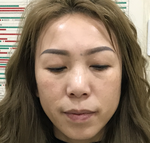去眼袋手术