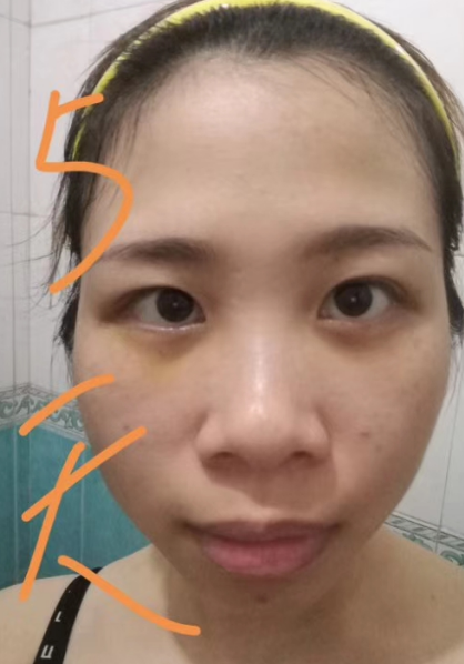 去眼袋手术