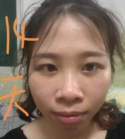去眼袋手术