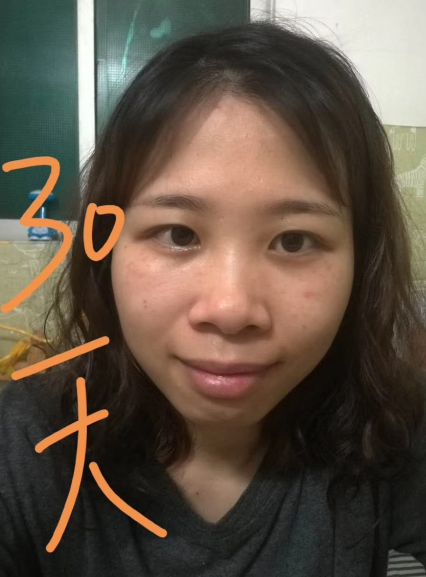 去眼袋手术