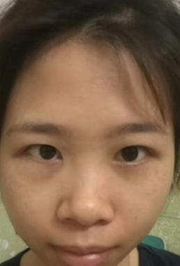 去眼袋手术