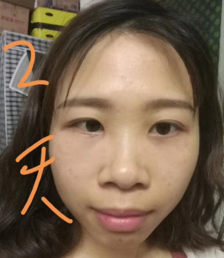 去眼袋手术